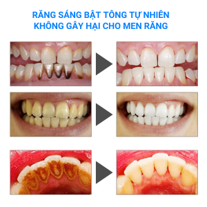 Răng sáng bật tông tự nhiên sau khi dùng sản phẩm