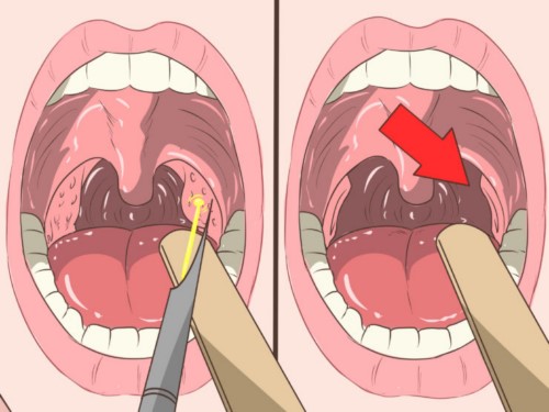 Bị hôi miệng là gì?