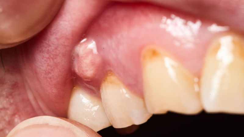 Lưỡi và nướu không sạch