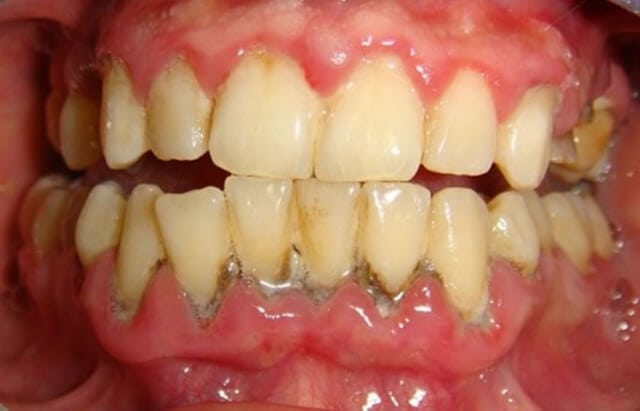 Ngăn ngừa các bệnh lý răng miệng